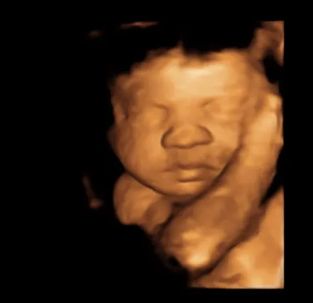 3D/4D ultrasound of a baby's face at 27 weeks
