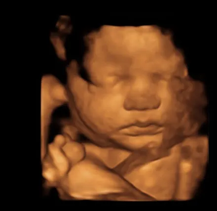 3D/4D ultrasound of a baby's face at 33 weeks