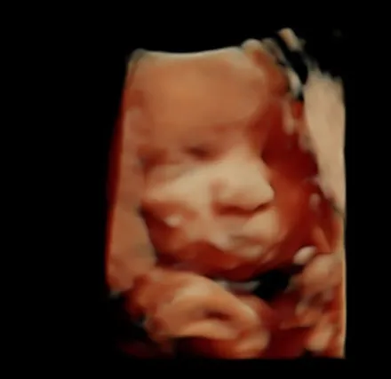 HDlive ultrasound of a baby's face at 30 weeks
