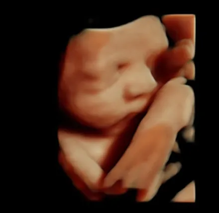 HDlive ultrasound of a baby's face resting against a hand at 32 weeks