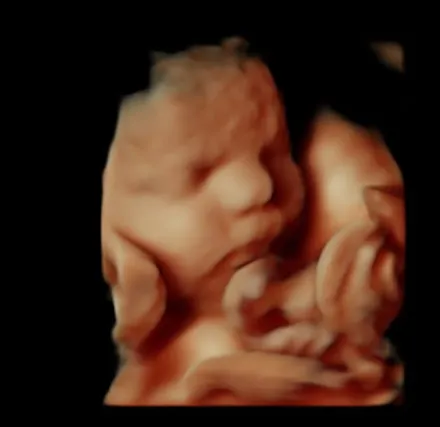 HDlive ultrasound of a baby's face at 31 weeks